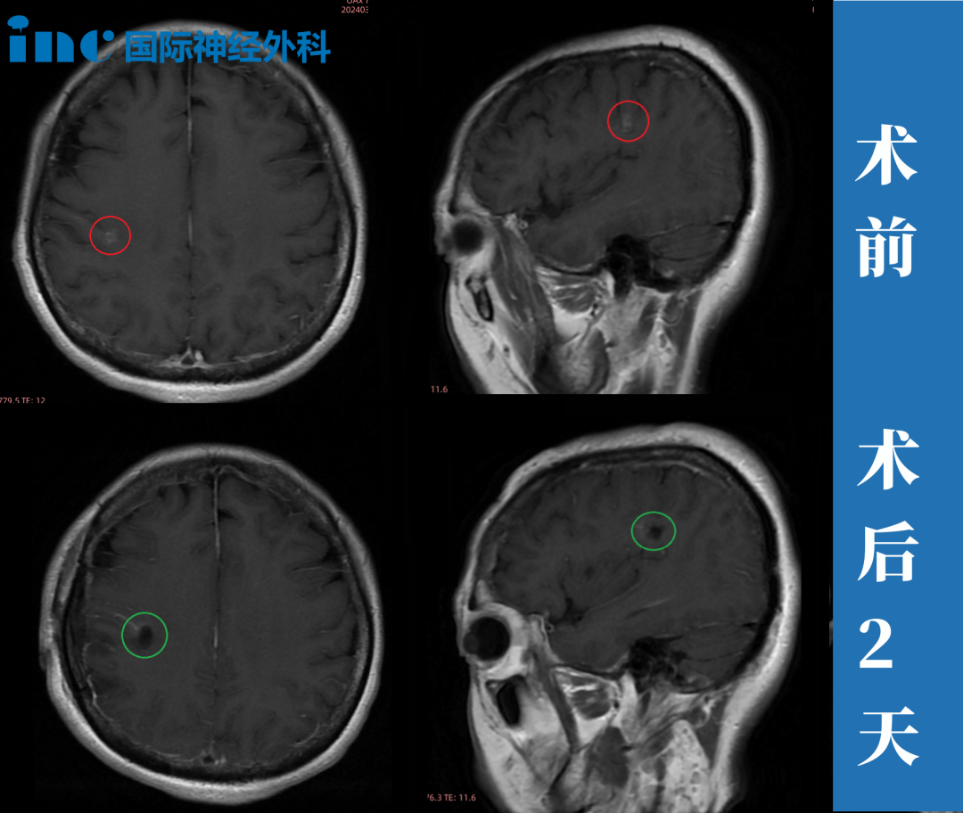 术前术后mri