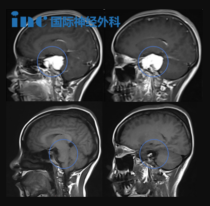 MRI影像