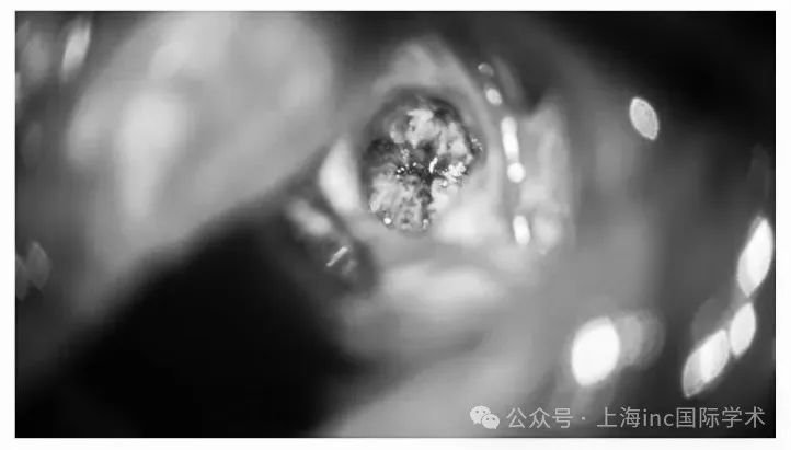 瘤腔止血彻底，血管瘤完整切除
