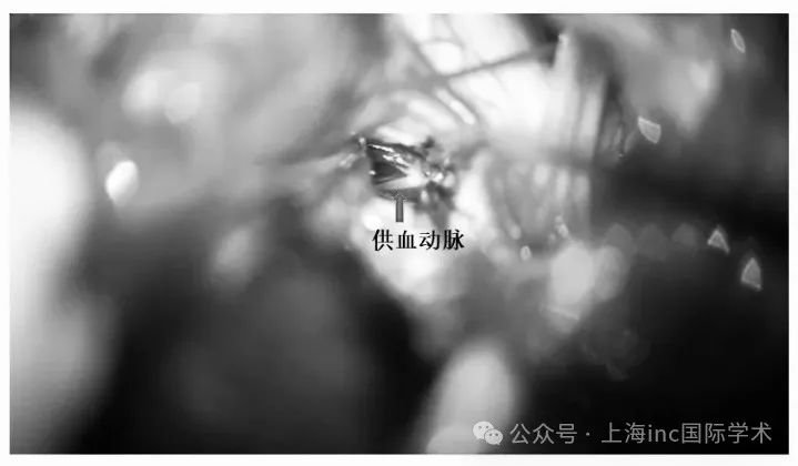 断除畸形血管团供血动脉