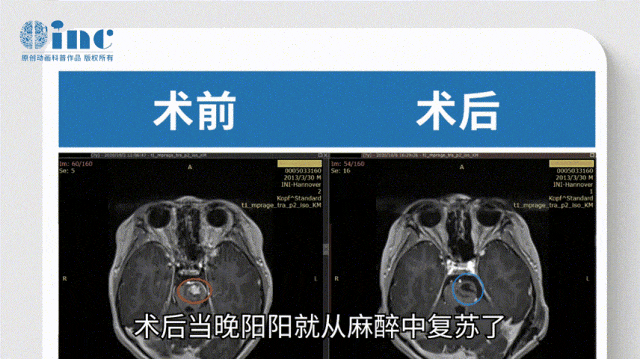 在术后回访中，阳阳已经活动自如，可以正常生活，有自理能力，并且恢复了原来的活泼好动。