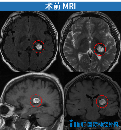 术前mri