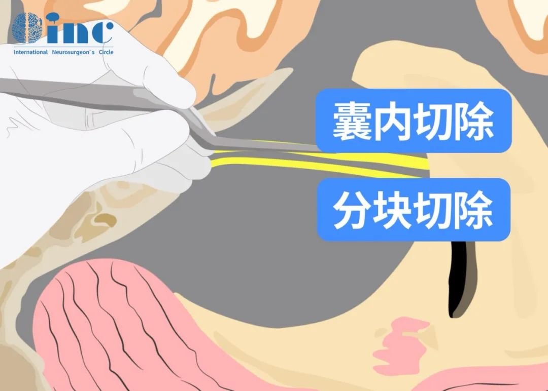 膜内肿瘤切除术
