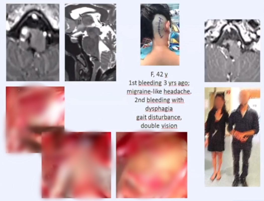案例4：第一次出血头痛，第二次出血吞咽困难，步态障碍、复视，术后恢复良好