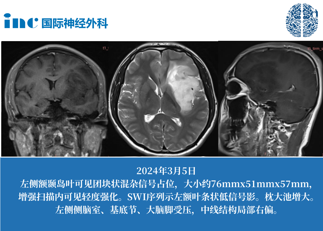 左侧岛叶巨大占位，考虑胶质瘤，却被告知手术风险很大，有偏瘫，失语风险。