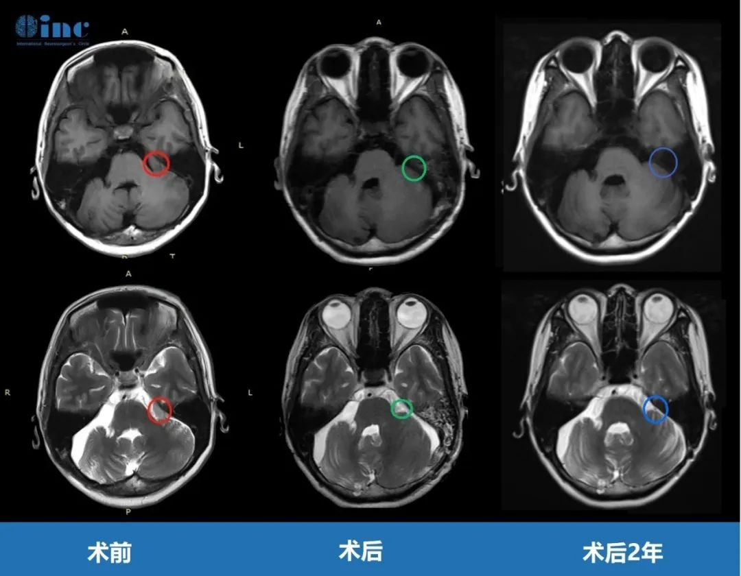 CPA区脑膜瘤手术治疗总结