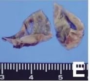 切除的动脉瘤照片显示部分薄壁，无钙化