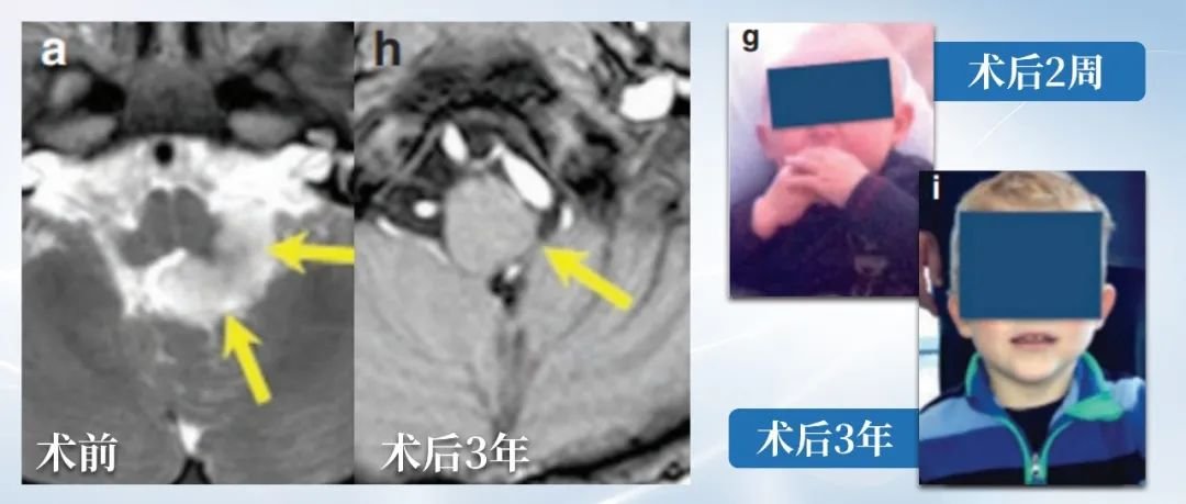 1岁宝宝脑干胶质瘤惊险求生！3年无复发，国际大咖如何突破＂手术禁区＂？