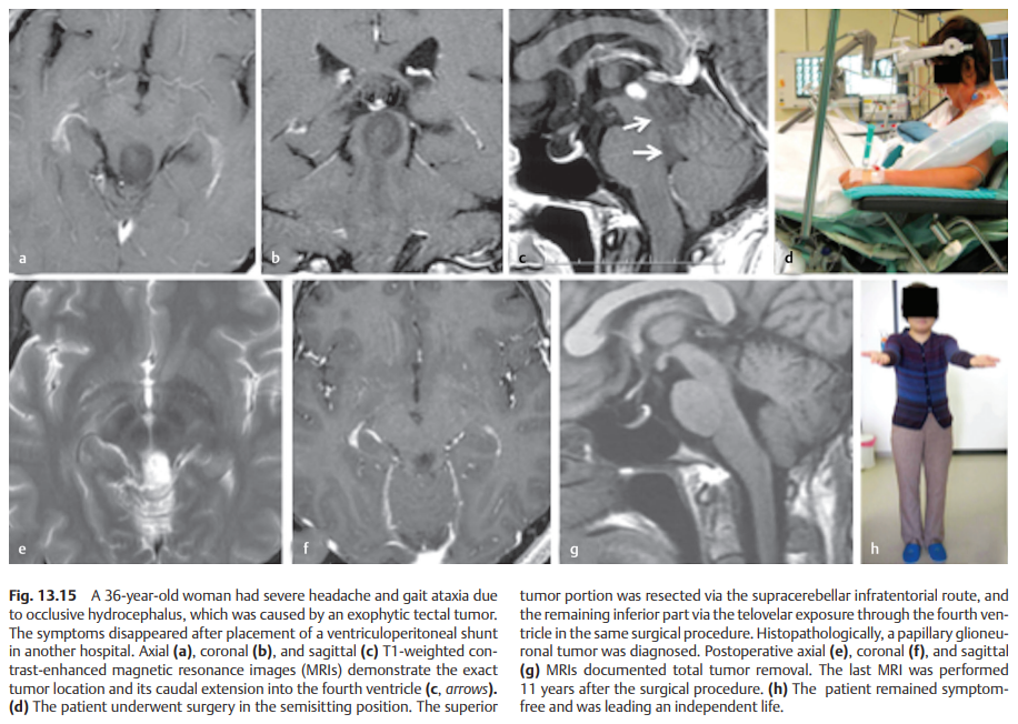 该案例来源于2020年新版的世界脑干手术专著《Surgery of the Brainstem》（脑干手术）中，巴特朗菲教授撰写的《adult brainstem glioma》（成人脑干胶质瘤）章节。