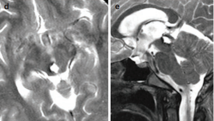 术前MRI