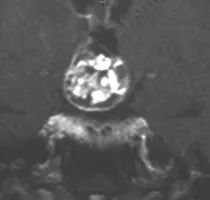 Daniel的脑部核磁共振（MRI）显示鞍区存在颅咽管瘤，已从向上生长侵入第三脑室。在内分泌检查中，他还被发现垂体功能部分不足。