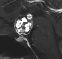 Daniel的脑部核磁共振（MRI）显示鞍区存在颅咽管瘤，已从向上生长侵入第三脑室。在内分泌检查中，他还被发现垂体功能部分不足。