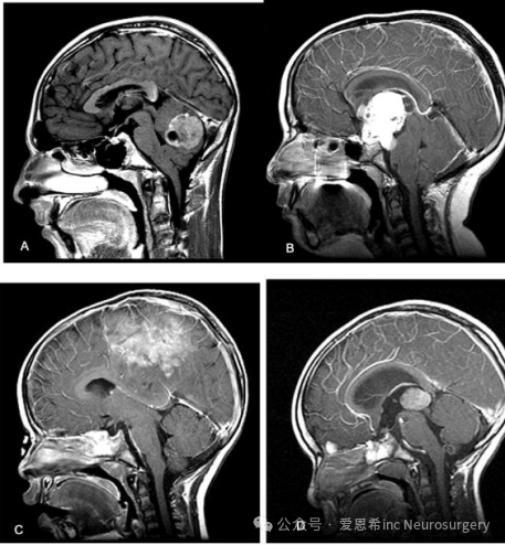 图1：不同脑区小儿脑肿瘤的矢状位 MRI。(A) 14 岁男性后颅窝肿瘤，有恶心、呕吐和头痛病史。手术时，病变证明是髓母细胞瘤。(B) 10 岁女性中线鞍上占位性病变伴内陷至第 3 脑室，伴有进行性视力丧失和头痛。这个肿瘤是颅咽管瘤。(C) 2 岁女性矢状旁肿瘤，有短暂的<a href='/dianxian/' target='_blank'><u>癫痫</u></a>发作和腿部无力病史。这个肿瘤是室管膜母细胞瘤。(D) 有呕吐和头痛病史的 2 岁男性第三脑室后方肿瘤。病变为松果体母细胞瘤。