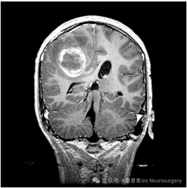 图3：对 14 岁男性 1 型神经纤维瘤病进行冠状 MRI 扫描，表现为突然发作的头痛。MRI 显示出血和肿瘤，并被证明是胶质母细胞瘤多形式手术。
