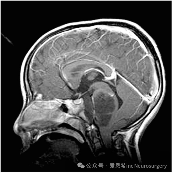 图4：MRI 显示一名自闭症儿童(同卵双胞胎之一)的弥漫性内源性脑桥神经胶质瘤。肿瘤不仅充满脑桥，还包裹着基底动脉。这些肿瘤的预后极差，大多数病例的生存期为 12 至 18 个月。