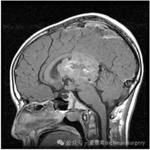 图5：14 岁男性脑室内室管膜瘤矢状 MRI，表现为头痛和记忆丧失的简短病史。