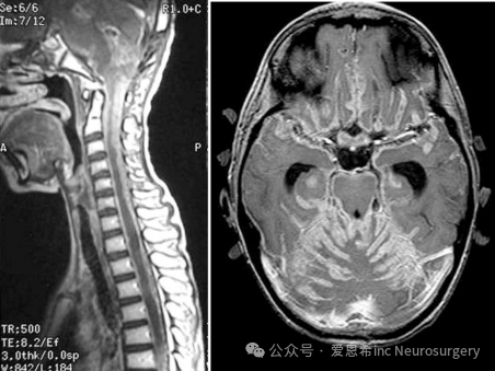 图6：播散性髓母细胞瘤的 MRI。（A） 在该矢状面 MRI 上可以看到脊髓有肿瘤覆盖。（B） 显示大脑的弥漫性软脑膜播种。