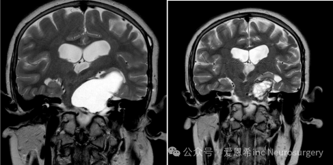 图7：囊性颅咽管瘤用 Ommaya 储液器和反复敲击保守治疗。冠状位 MRI 扫描显示 (A) 插入 Ommaya 储液器之前和 (B) 插入 Ommaya 储液器之后和重复敲击后;显示囊肿大小显著减小。