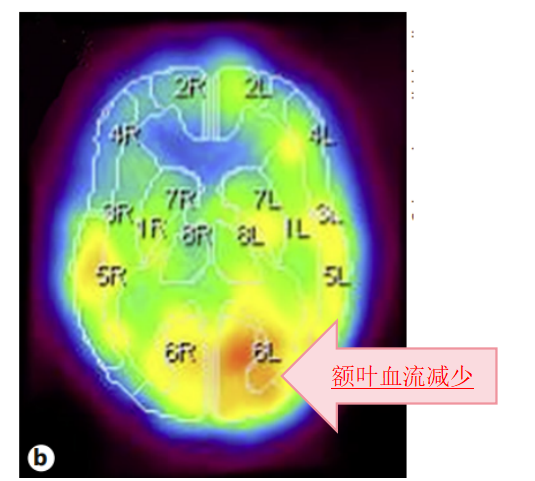 右侧额叶明显的脑血流减少、代谢低，提示既往脑梗病史。