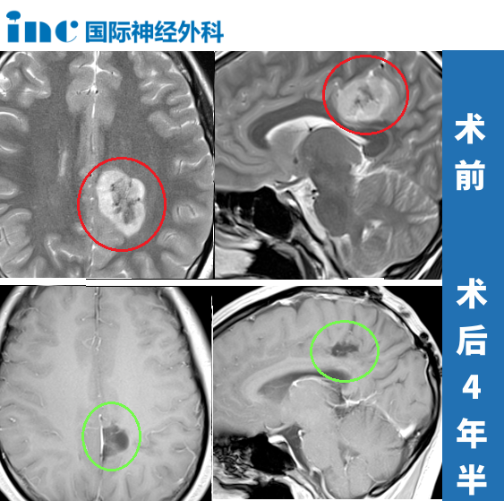 从「开颅手术要瘫」到术后2天下床、8天出院，脑瘤术后4年她发来感恩「表白」
