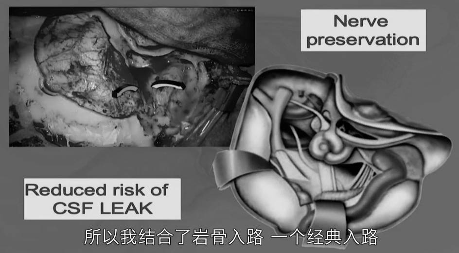 联合岩骨入路不仅可以显著降低脑脊液漏的风险，还能进一步保护神经，不需要切除正常的脑组织（天幕）就能够直接抵达并剥离肿瘤