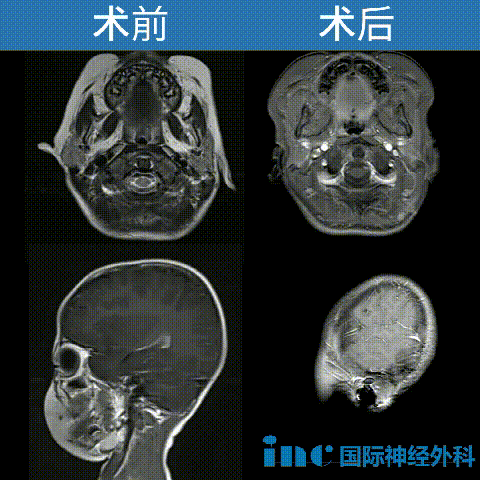天坛医院手术纪实 | 一次摔倒，竟摔出了“潜伏”在脑干的胶质瘤！