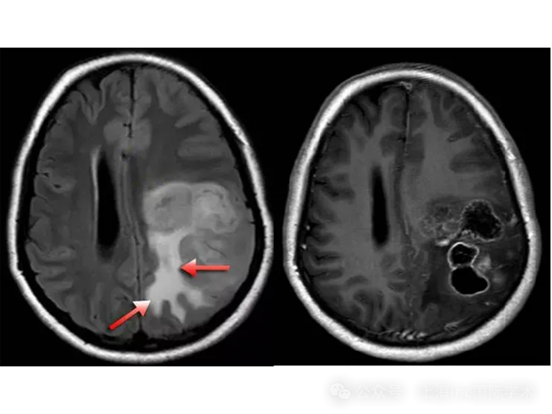 FLAIR序列肿瘤为稍高信号，肿瘤周围白质内见不规则形高信号水肿，勾勒出局部脑白质形态，水肿呈指套样伸向白质。