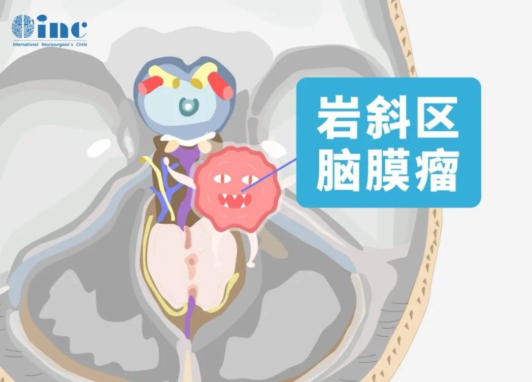 岩斜区脑膜瘤