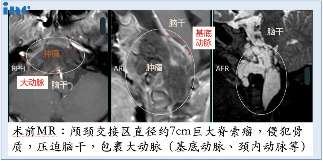 福教授最终决定进行单鼻孔入路神经内镜手术，采用多种角度镜，运用“筷子技术”，用仅仅8mm的创口，切除了直径达50mm的肿瘤。在减少出血点的同时，将手术风险尽可能降到很低。