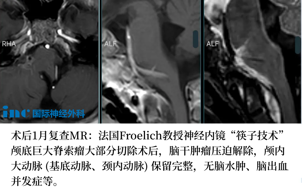 术后两天，林林顺利转出ICU，无新增并发症。术后10天，林林顺利出院。