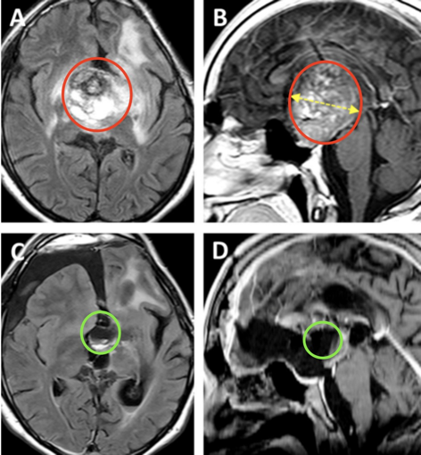图A、B为术前MRI影像。图C、D显示为几乎全切的术后MRI