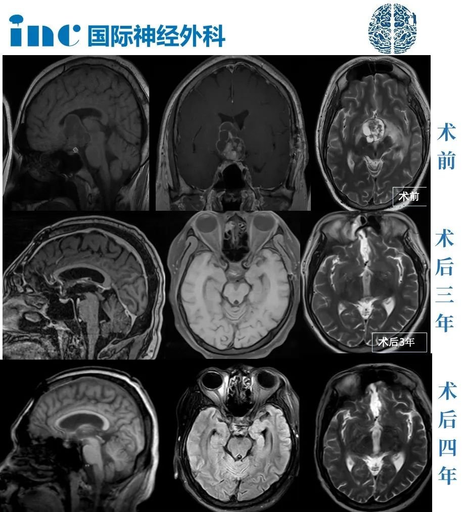 首次开颅却赶不走脑子里这个“祸害”，正值壮年的高先生终于下定决心要铲除这个害他失去正常生活的“颅咽管瘤”，最终找到INC巴教授。