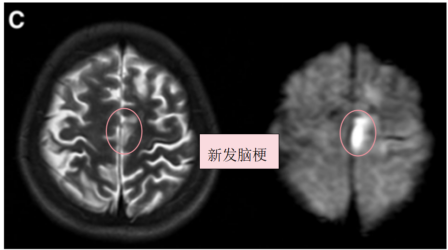 术前T2、DWI序列显示左额叶新发展的脑梗死。