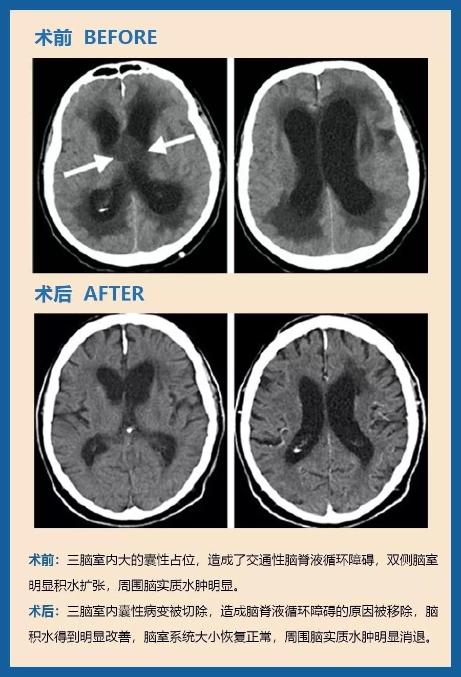 72岁，颅咽管瘤，缓慢进行性精神衰退