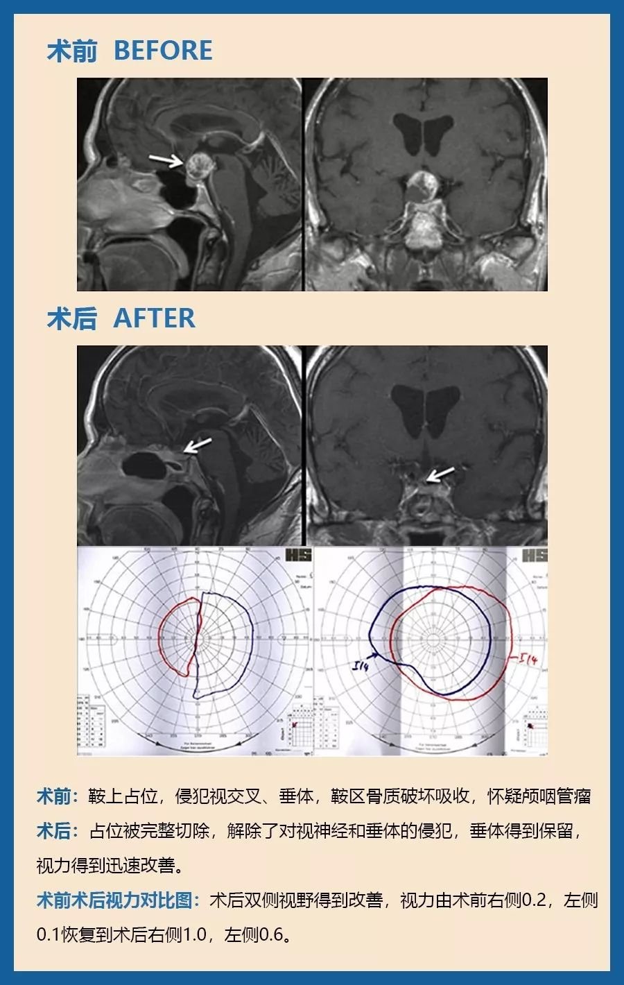 57岁，高度视力丧失、视野受限，颅咽管瘤。眼科检查显示左侧0.1和右侧0.2的视力以及高级双时间偏盲。