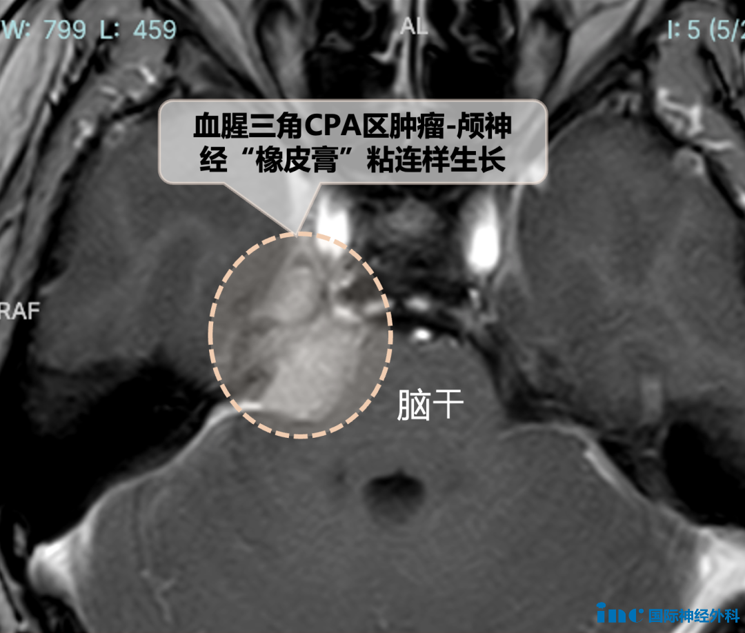 小小肿瘤却长得刁钻，和脑神经中最细的神经滑车神经、三叉神经间呈“橡皮膏关系”——黏得严严实实！