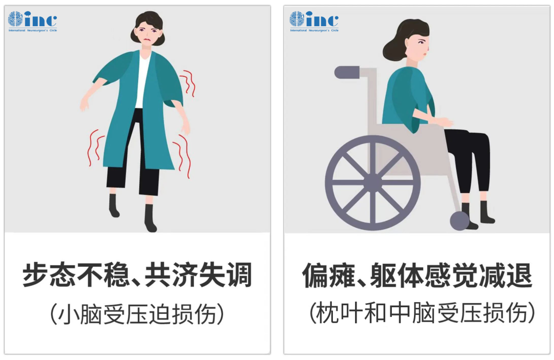 被保留下来的脑膜瘤随着时间流逝，会慢慢长大，向下生长压迫小脑，会走路不稳、共济失调。