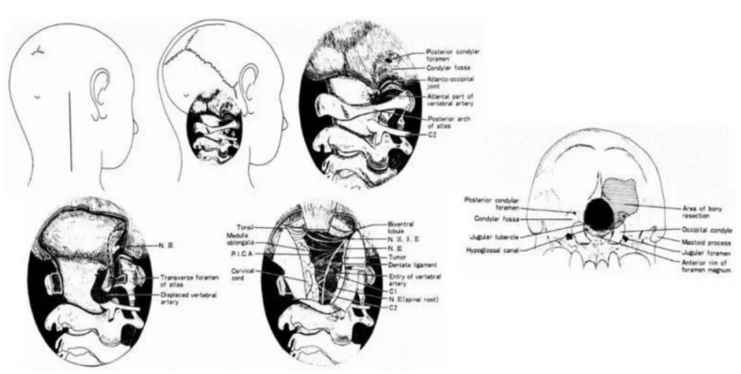 巴特朗菲教授和其导师Seeger(1991)提出的“dorsolateral , suboccipital , transcondylar approach”入路
