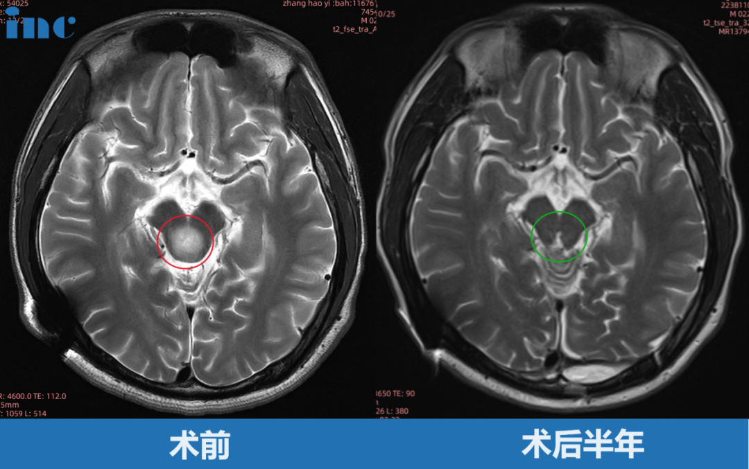 巴教授术后半年随访中，影像显示肿瘤没有残留，更没有复发。