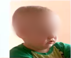 ＂这孩子没法手术＂→视路胶质瘤全切！2岁男孩小脑袋里的大战役