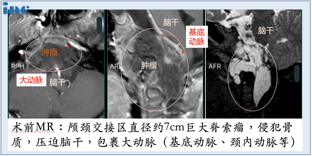肿瘤位置特殊，体积巨大，明显压迫脑干，林林在国内接受了第一次手术，部分减少肿瘤的体积。