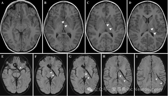 图3.轴位T1加权MRI(A-D)和磁敏感加权成像(E-I)显示右额叶基底脑实质出血(星号)，并伴有从血肿后方延伸至左侧颞叶的线性轨迹(箭头)，该轨迹经过胼胝体膝部、左侧苍白球、内囊前肢和左侧后部岛叶。这与穿透右侧眼眶的损伤一致。