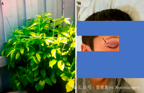 图1. 照片显示了导致创伤的物体，即花园尖桩(箭头，A)，该尖桩穿透了患者的右侧眼眶，患者出现了瘀伤、眼周肿胀以及右眉下方的擦伤(箭头)，这些迹象表明了花园尖桩的入口点(B)。