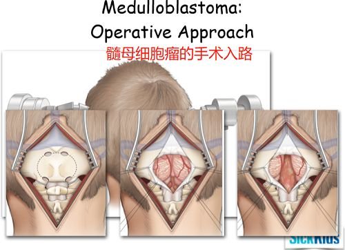 任何手术都要保证安全性，尽量不对大脑功能造成损伤。
