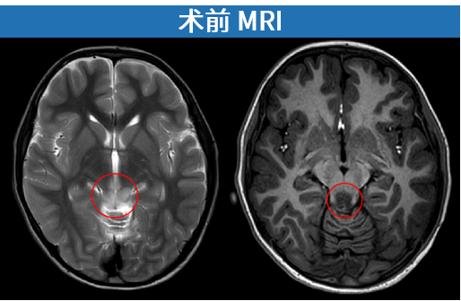 术前MRI