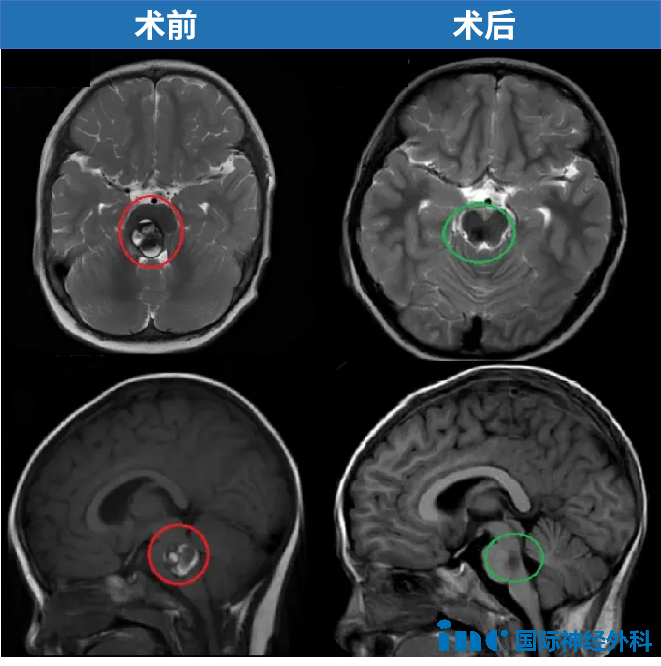 2岁，聪聪，脑干-脑桥海绵状血管瘤，2019年巴教授中国示范手术，顺利全切肿瘤，目前已经在上小学。