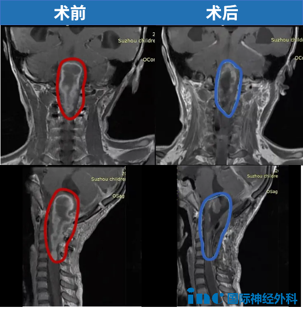6岁，琦琦，脑干延髓，一直延伸至颈5节段脊髓，巴教授中国示范手术，肿瘤几近全切。术后3年，琦琦可以像正常孩子一样玩耍。