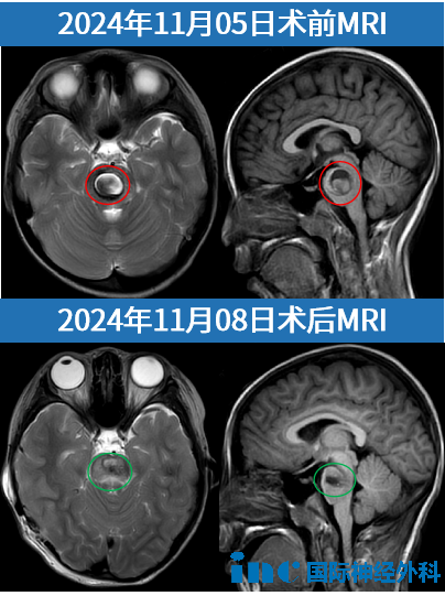 7岁女孩萌萌，脑干海绵状血管瘤突发出血，120紧急转运至苏州大学附属儿童医院，巴教授顺利全切血管畸形。短短2天时间，从发病到成功手术……