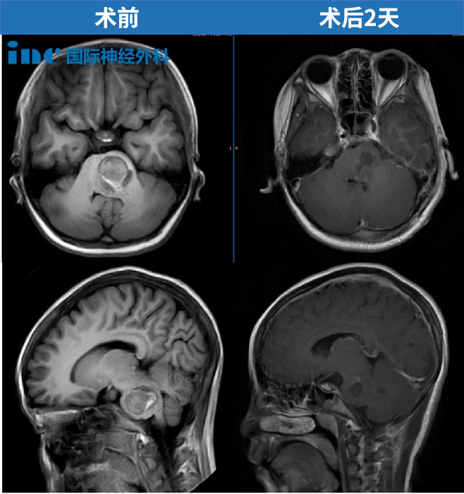 11岁，贝贝，脑干海绵状血管瘤出血，120急救送进ICU、病情危急，2024年巴教授为其成功示范手术，目前已回归校园。