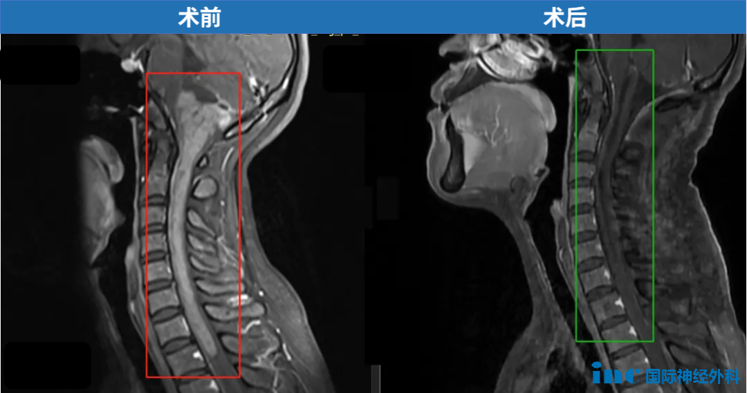 33岁，郑女士，15cm肿瘤起源于脑干下部，累及延髓和颅颈交界区，且向下方延伸到整个颈部脊髓以及一直到第一胸椎水平，巴教授成功示范手术。